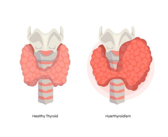 Best Thyroid Disorders Treatment in Rajendra Nagar